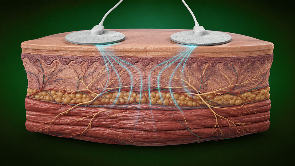 Frequency Specific Microcurrent Therapy in Amherst, NY